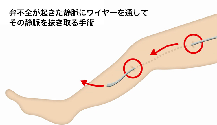ストリッピング手術